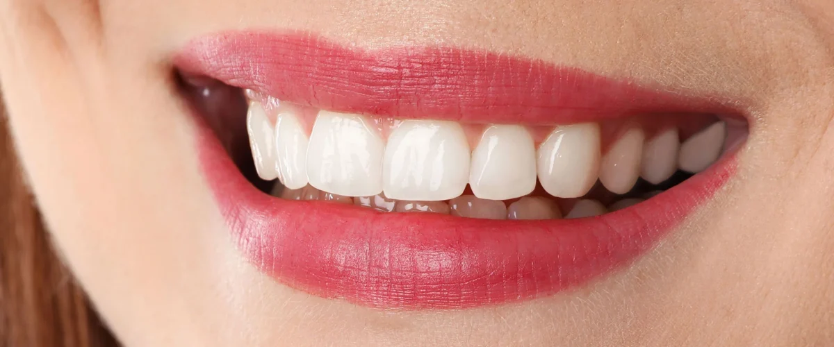 Dinți după fațete dentare în Constanța – zâmbet alb și perfect