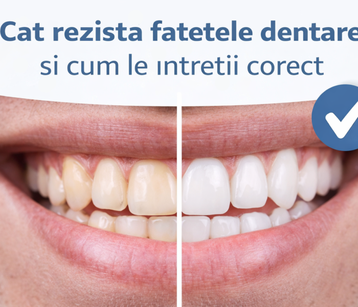 Cât rezistă fațetele dentare și cum le întreții corect