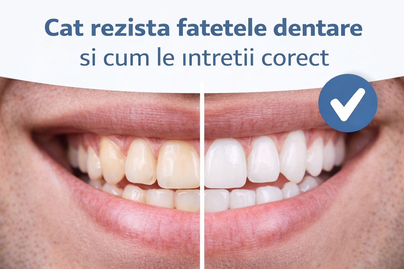 Cât rezistă fațetele dentare și cum le întreții corect